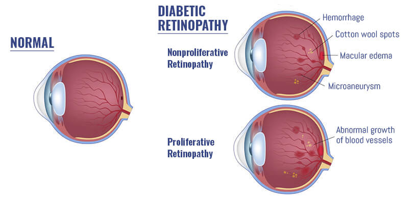 Normal Eye vs Eye with Diabetic Retinopathy