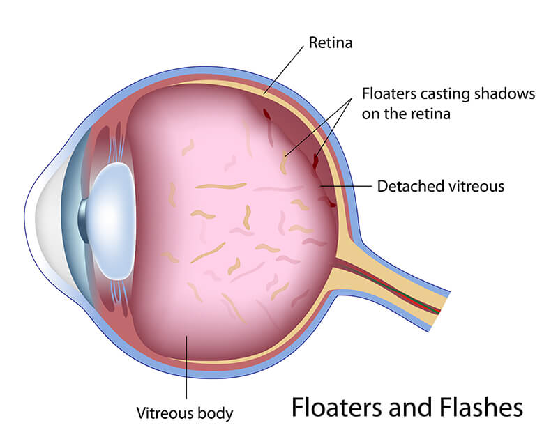 Chart Showing How Flashes and Floaters are Caused in the Eye