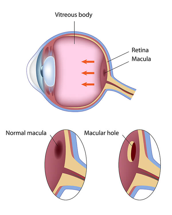 Chart Showing a Macular Hole in an Eye