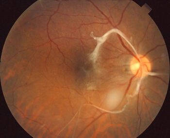 Eye Scan Showing Macular Pucker