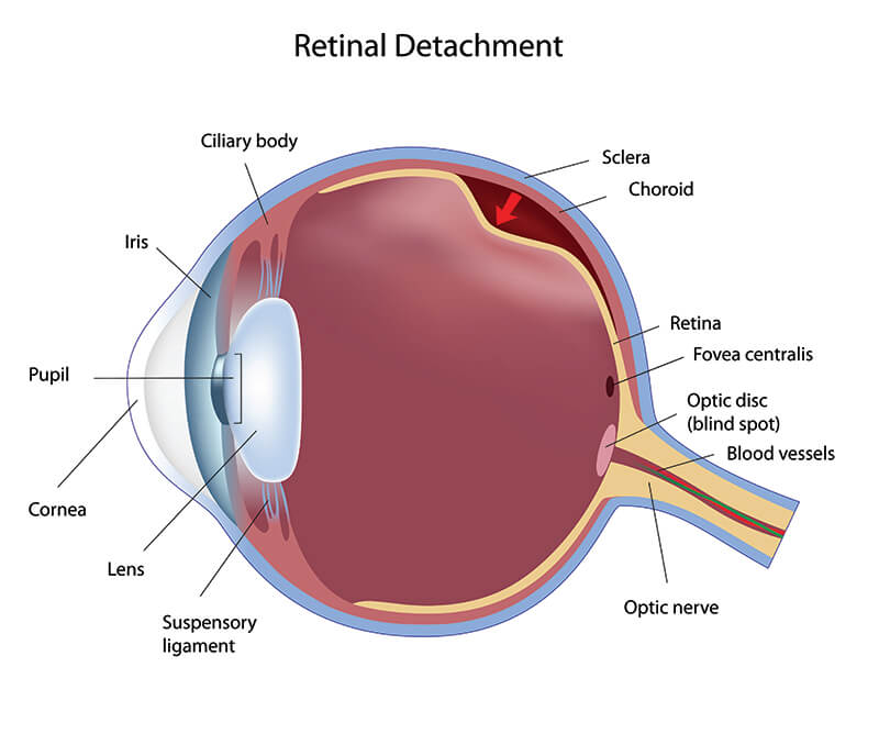 Retinal Detachment