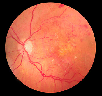 Eye scan showing a retinal vein occlusion